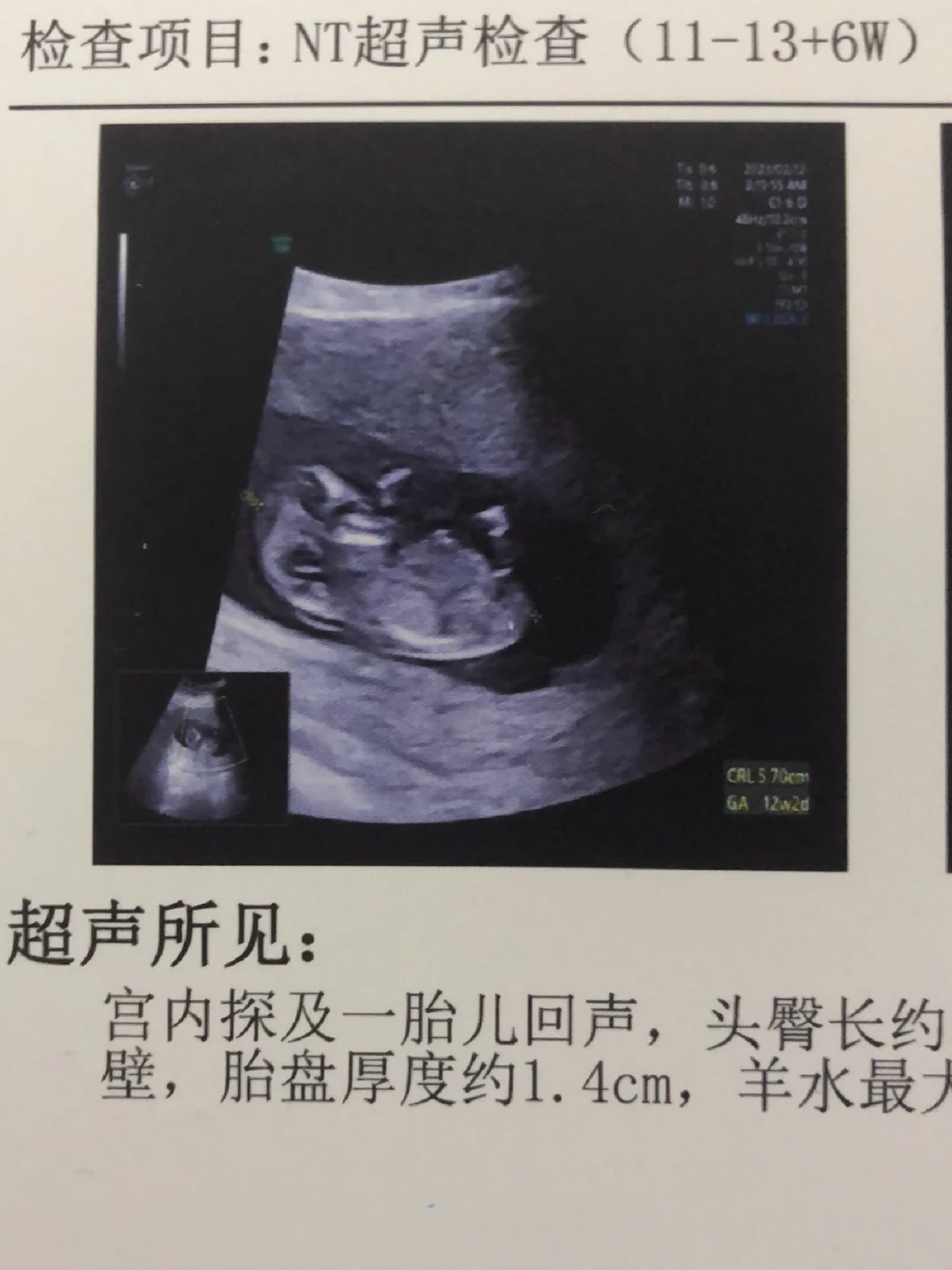 怀孕检查多久出结果？初期必做检查有哪些？